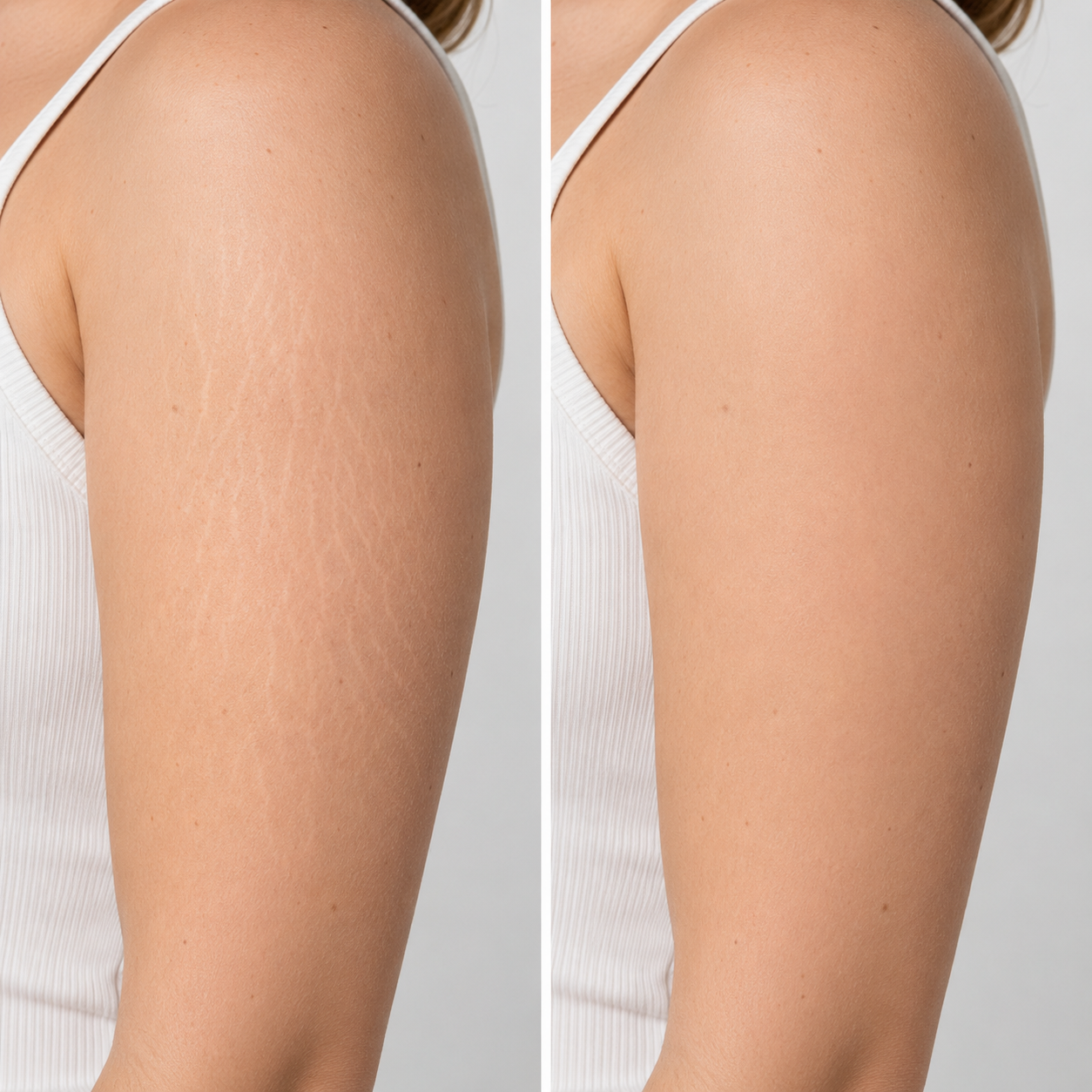 Stretch Marks Oil