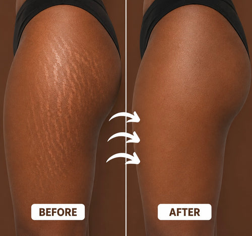 Stretch Marks Oil